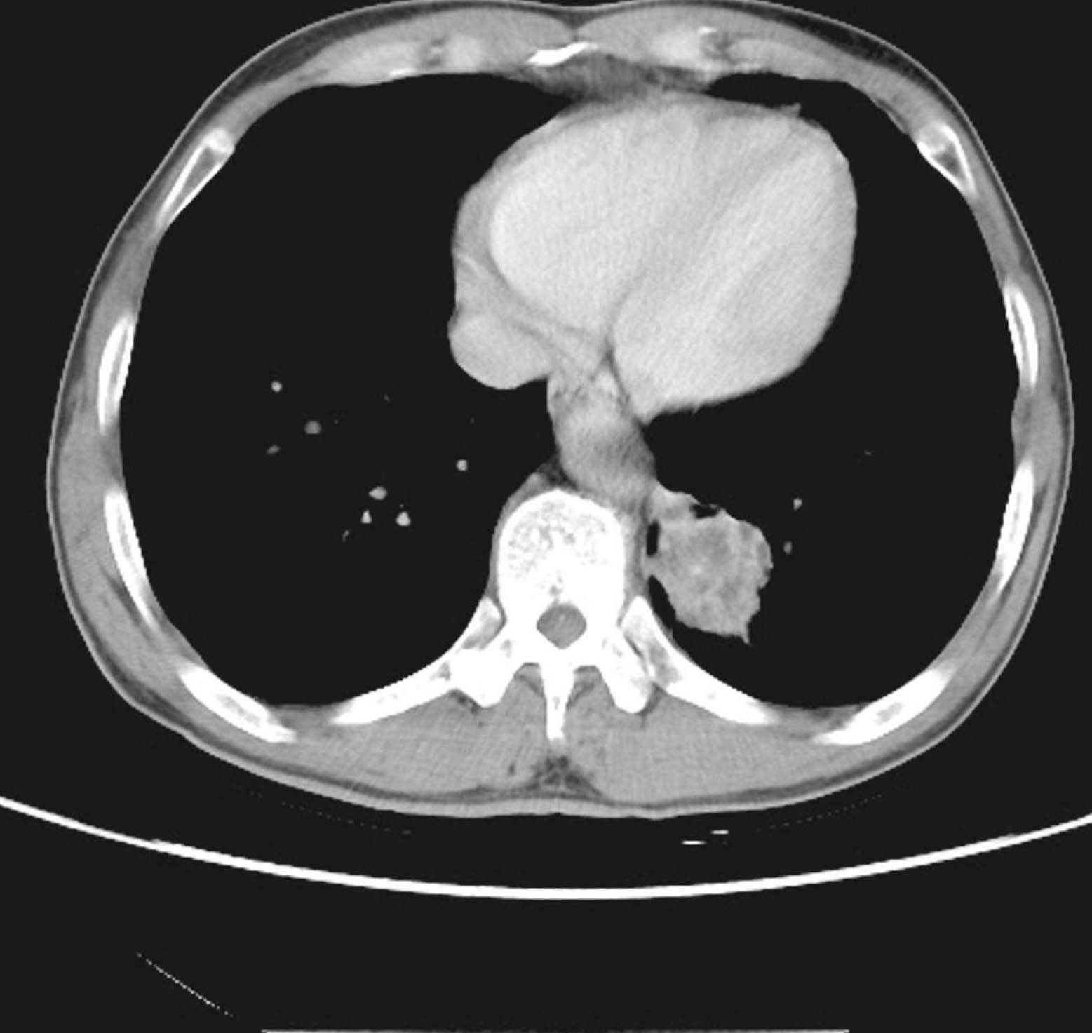 第二节 不同组织类型肺癌的CT表现